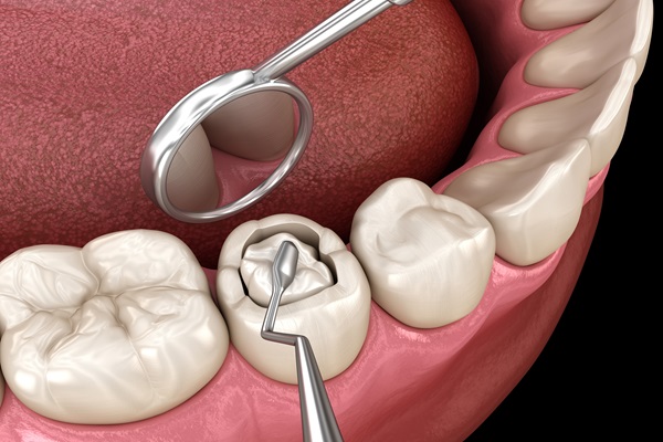 Tooth Filling at Keluarga Dental Smile, Sentul Kuala Lumpur